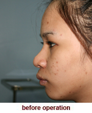 plastic_surgery_augmentation_rhinoplasty